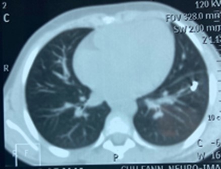 Foreign body in the left lower pulmonary lobe