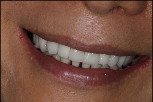 High-Quality Dental Implant Results New Albany OH