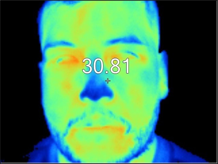 Facial thermography of the patient, where an elevation of temperature is seen in the region of the inner canthus of the right eye. The temperature is in degrees Celsius.