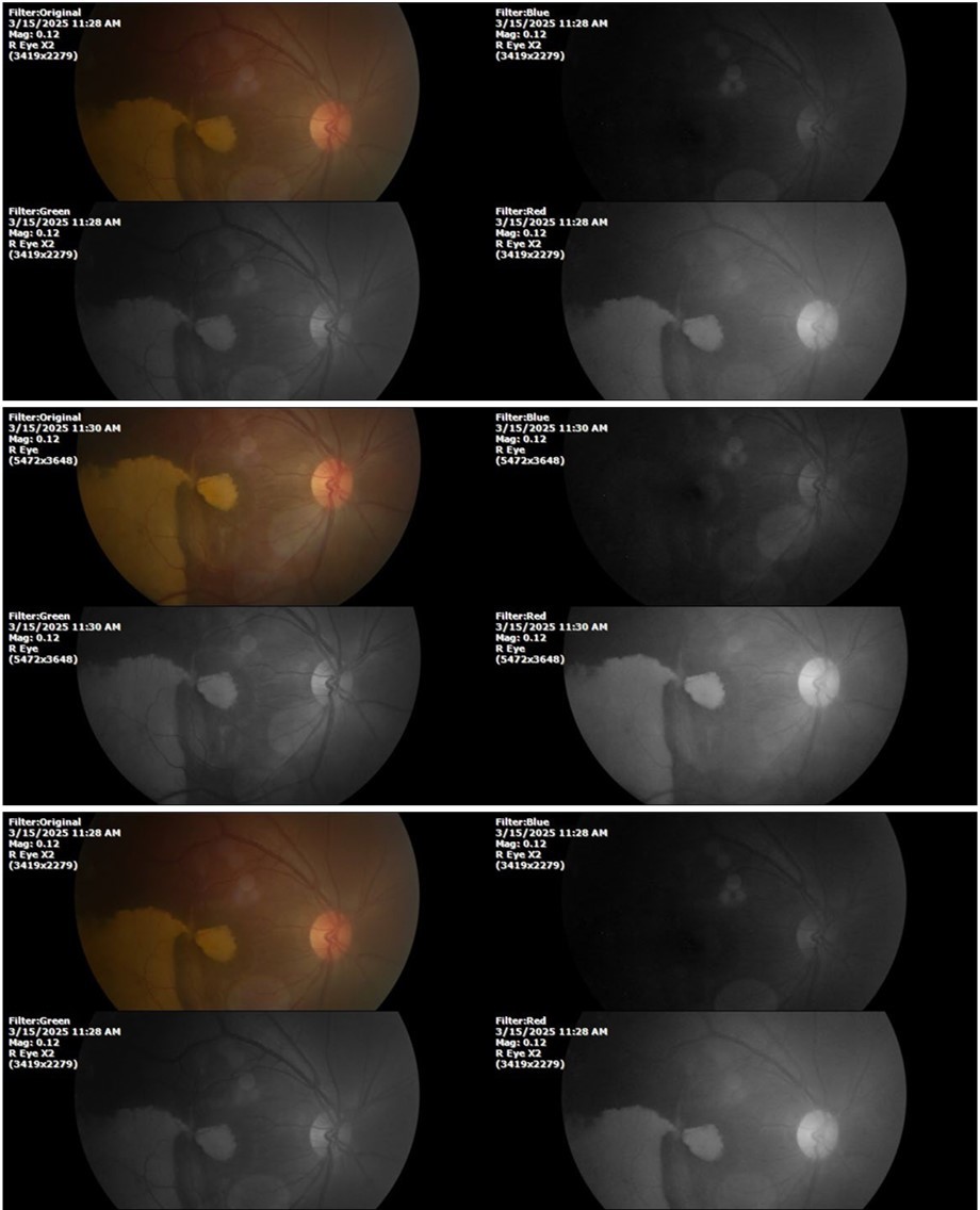 The three previous photographs of the right fundus show that the whitish mass composed mainly of phantom cells continues to decrease.