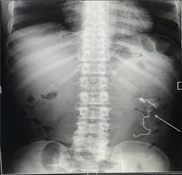 Erect abdominal X-Ray showing an ill-defined opacification in the left lumbar region (arrowed).