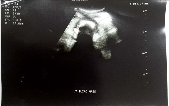 Abdominopelvic USG: An echogenic mass in the left iliac region measuring about 4.1cm in diameter. There was no flow on colour doppler interrogation.