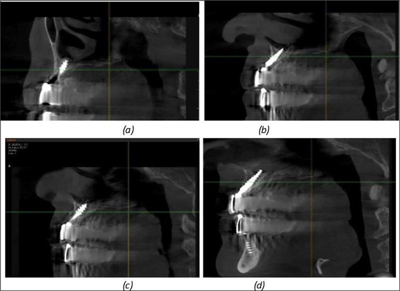 Implants in the anterior area anchored in the nasal cortex (BCS and TPG): (a), (c) – BCS implants fixed in the nasal cortex; (b), (d) – TPG implants fixed in the second nasal cortex with compression in the trabecular area.