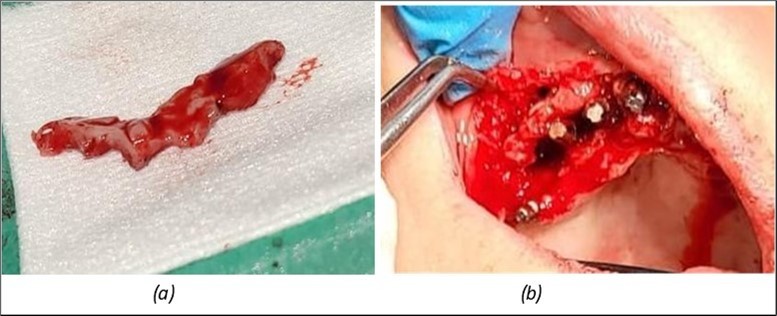 Repair of the frontal area with connective tissue harvested from the marginal palatal area after extraction and crest regularization: (a) mucosal tissue piece harvested from the frontal palatal area before preparation; (b) prepared connective tissue piece placed between the frontal implants under the mobile mucosa.