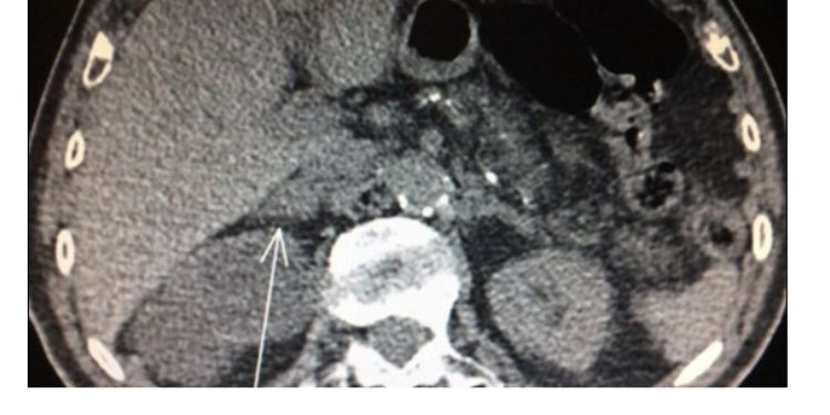 Journal of Respiratory Diseases-adrenal metastases